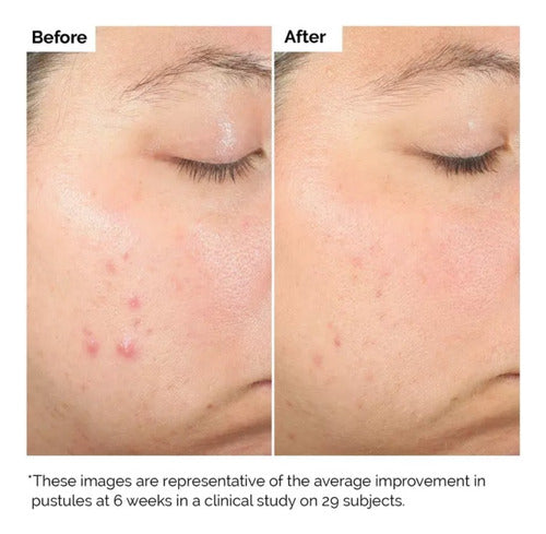 The Ordinary Salicylic Acid 2% Sérum 30 Ml Normal Noche