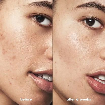 E.l.f. Skin Belmish Breakthrough Gel Antiacné
