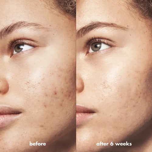 E.l.f. Skin Belmish Breakthrough Gel Antiacné