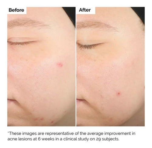 The Ordinary Salicylic Acid 2% Sérum 30 Ml Normal Noche