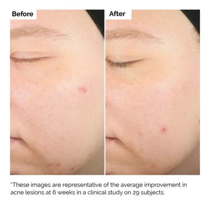 The Ordinary Salicylic Acid 2% Sérum 30 Ml Normal Noche